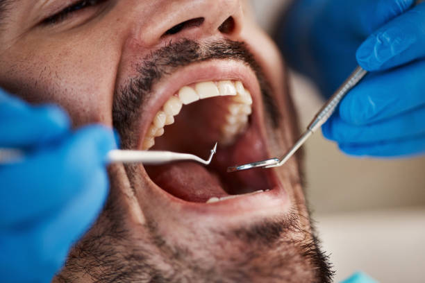 Best Emergency Dental Extractions in Mountain Brook, AL